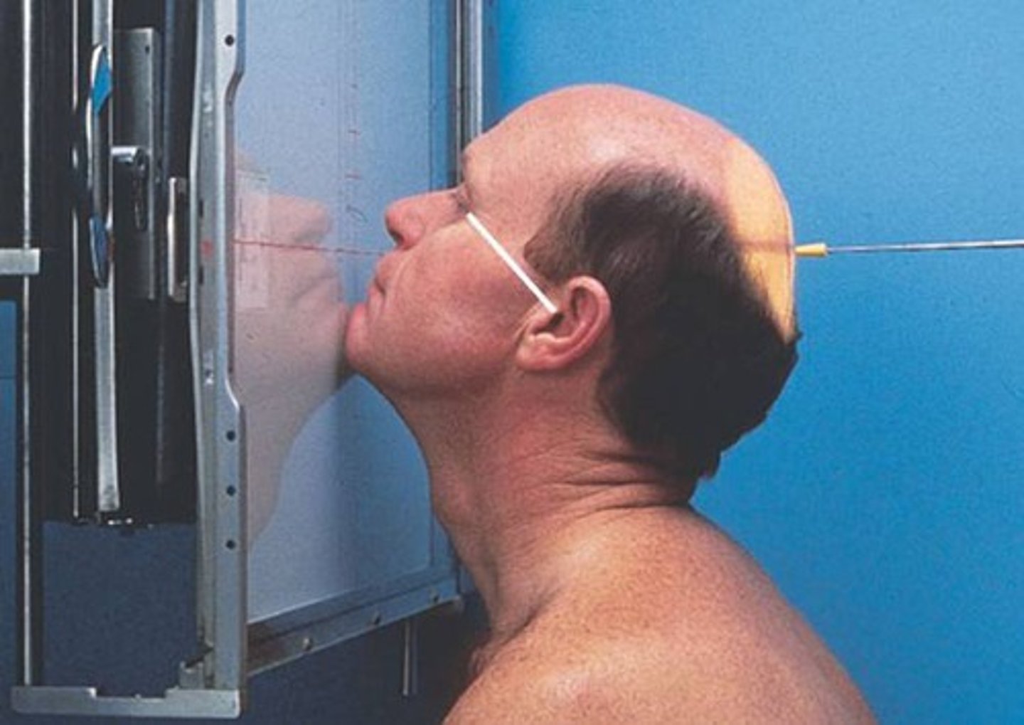 <p>Enters at the parietal (back top of the skull)</p>