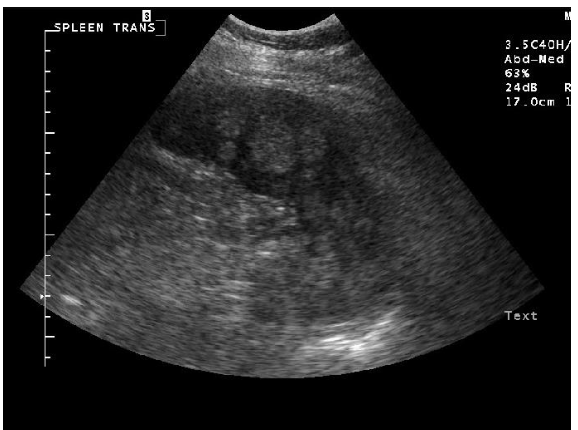 <p>what echotexture is shown?</p>