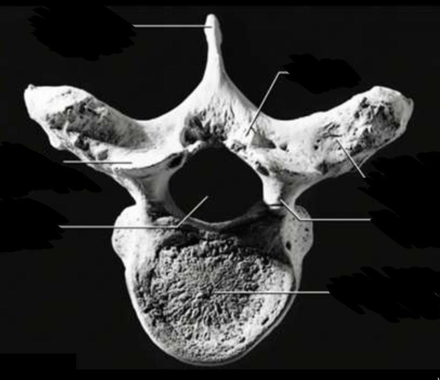 <p>Identify the vertebral foramen</p>