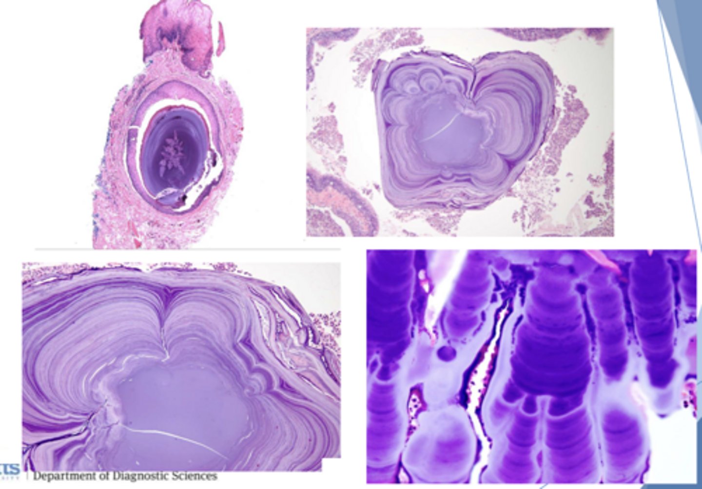 <p>ID the pathology based on the histology findings:</p><p>- Laminated calcified structure with central nidus</p>