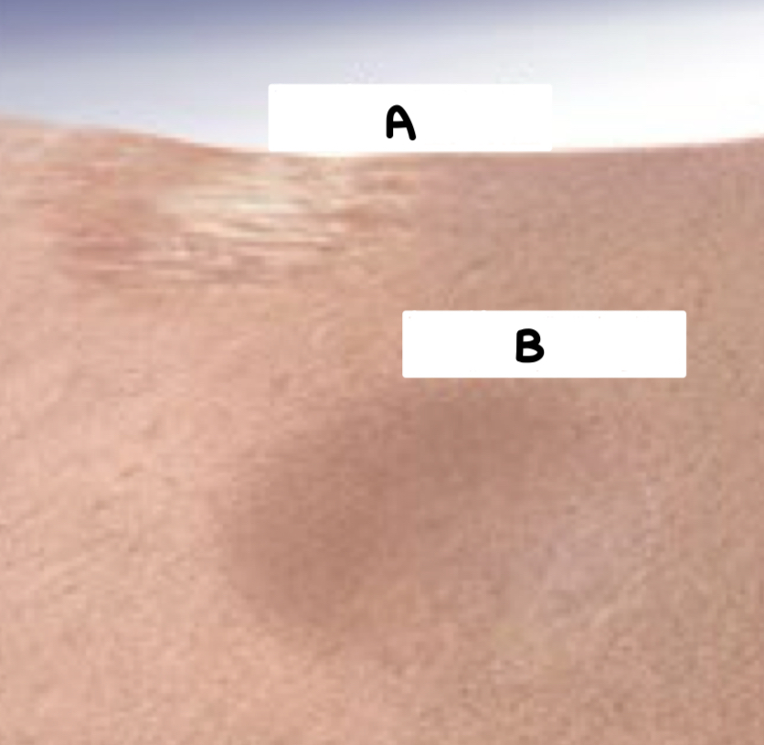 <p>what type of condition is depicted by B</p>