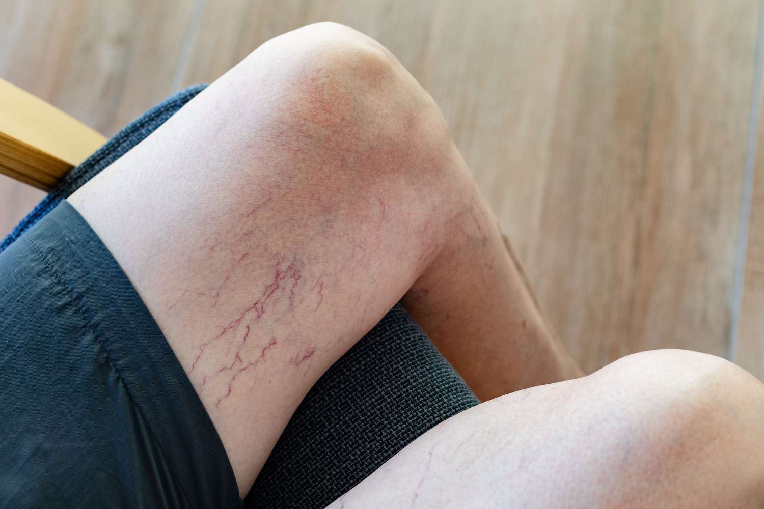<p>dilated small blood vessels near the surface of the skin, often appearing as red or purple lines </p>