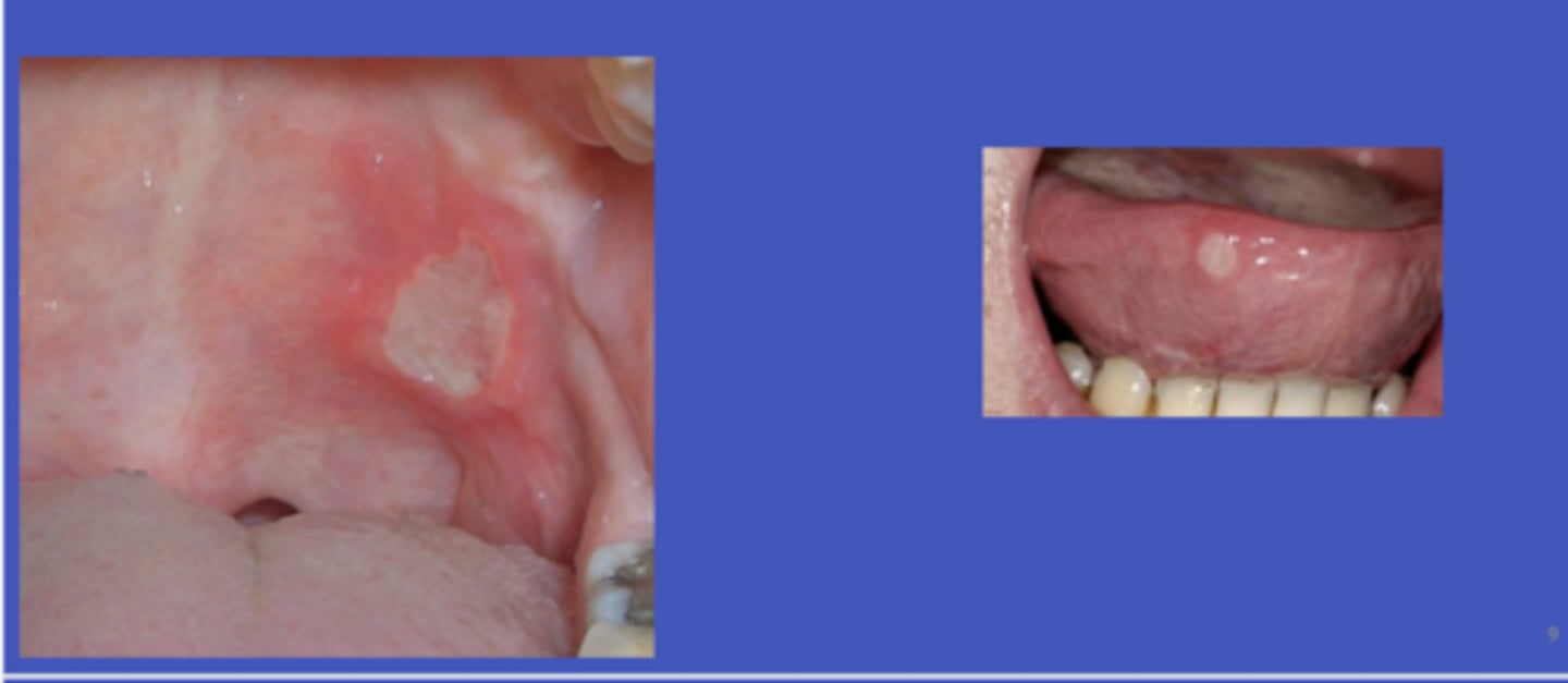 <p>True - multiple recurrent symptomatic irregular ulcers on nonkeratinized tissue</p><p>- smoking increases amount of keratinization, so when you quit, you will lose that keratinization, which increases risk for aphthous ulcers</p>