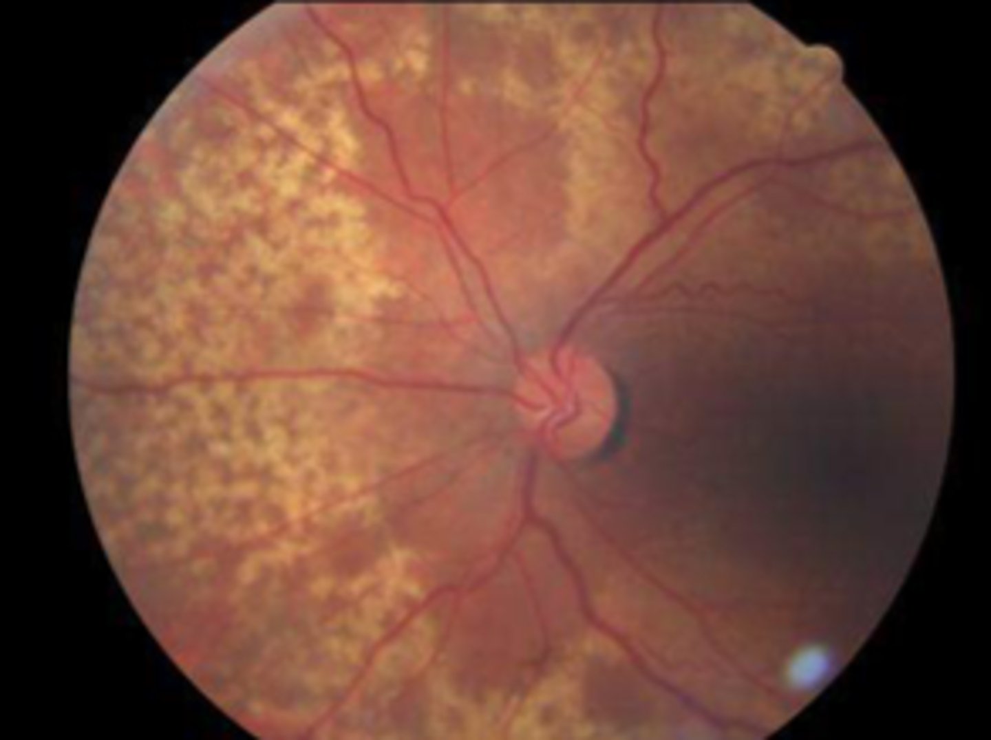 <p>Peripheral drusen</p><p>•Deposits of material on Bruch's membrane</p><p>•Found in over 70% of patients over 50 years of age</p><p>•Histologically similar to macula drusen</p><p>•Benign (as long as not approaching macula) and not associated with</p><p>any other conditions</p>
