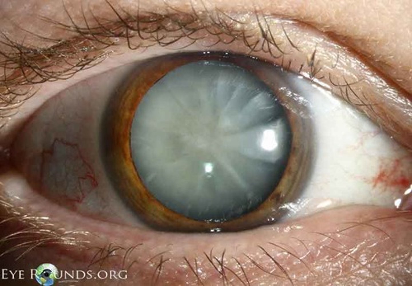 <p>Cataract</p>