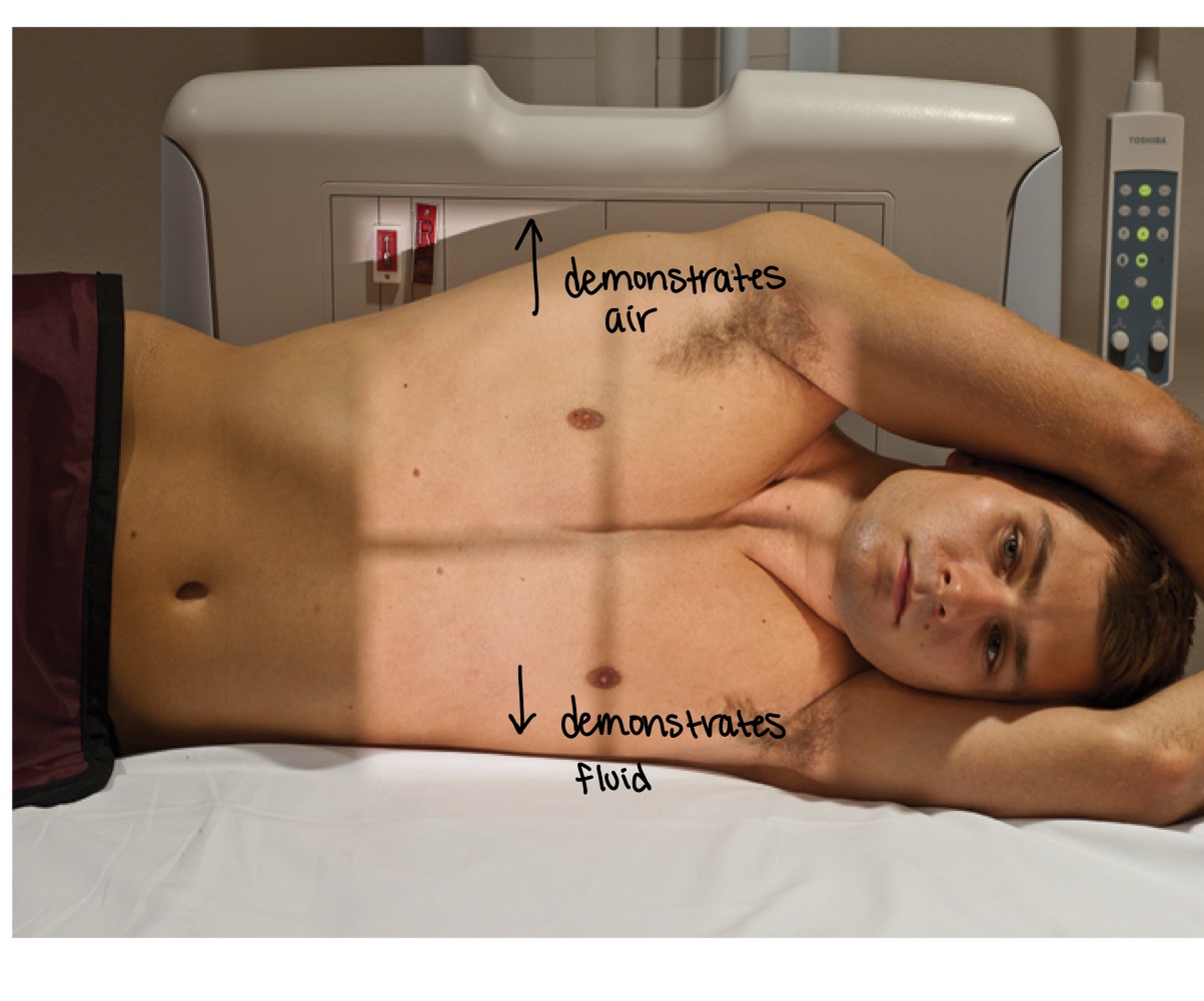 <p>Chest radiographs taken with patient lying on one side to show air or fluid levels.</p>