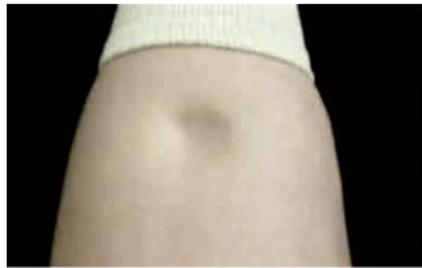 <p>where fluid pools in gravity-dependent areas-may be a sign of systemic. also known as pitting edema</p>