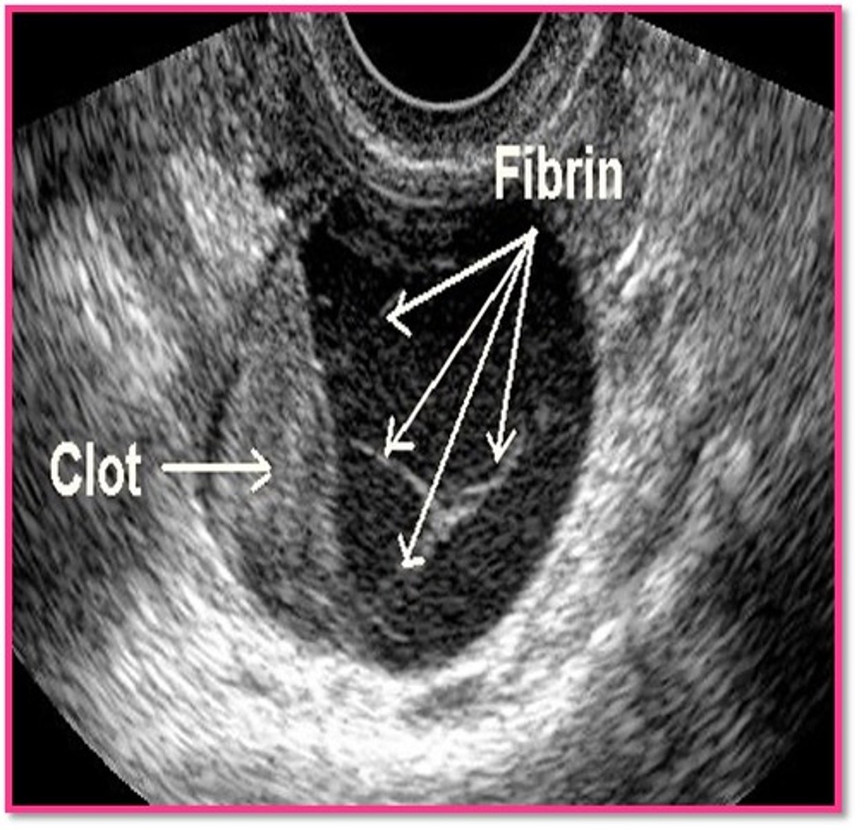 <p>complex; echogenic; fluid</p>