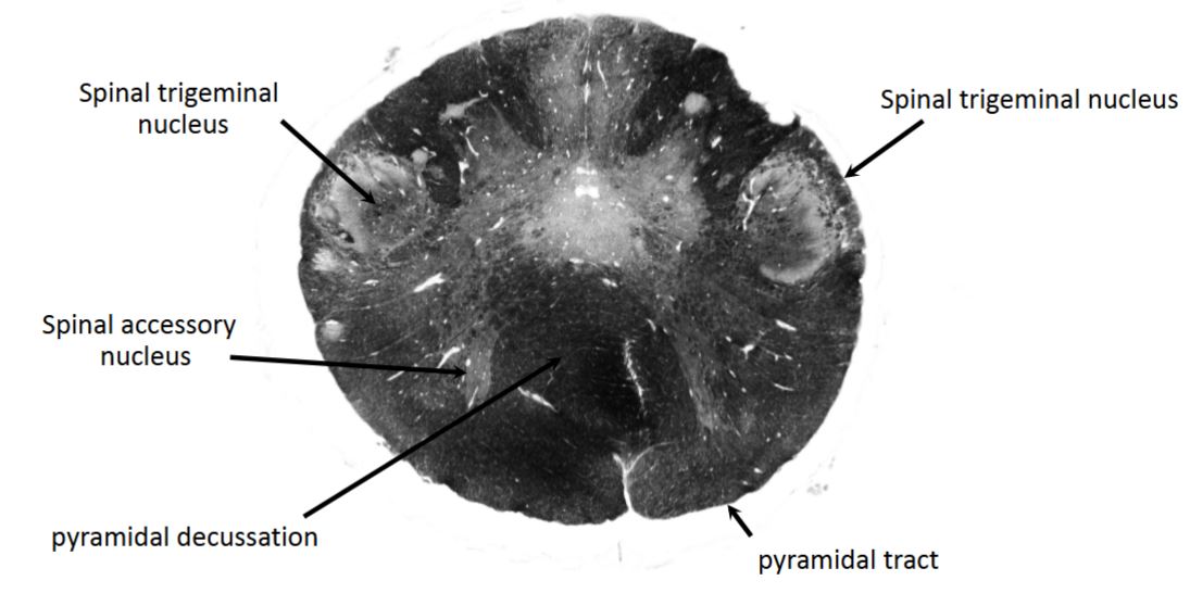 <p>pyramidal decussation</p>