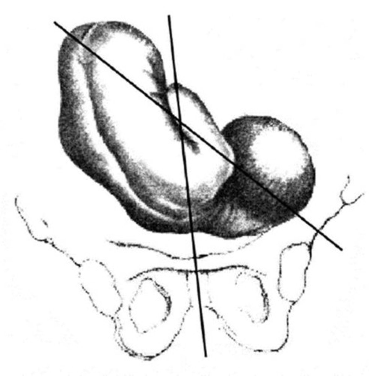 <p>an angle between the longitudinal lie and transverse lie</p>