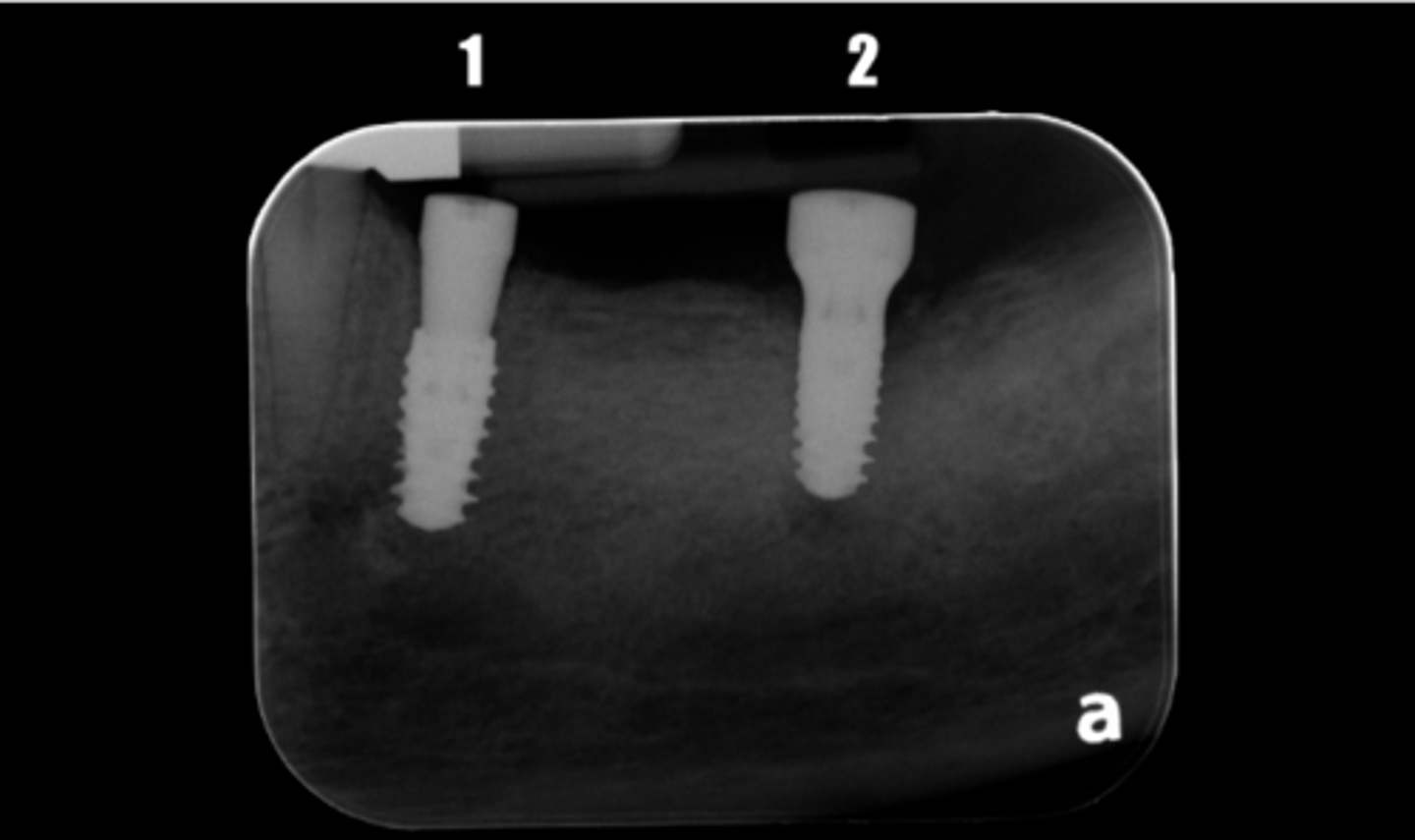 <p>. Based on the figure provided, please select the correct sentence. (Select two)</p><p>a. 2 should be tissue level implant with healing abutment</p><p>b. 1 should be bone level implant with a cover screw</p><p>c. 1 should be bone level implant with healing abutment.</p><p>d. 2 should be bone level implant with cover screw</p><p>e. 1 should be tissue level implant with healing abutment</p><p>f. 2 should be tissue level implant with cover screw</p><p>g. 2 should be bone level implant with haling abutment</p><p>h. 1 should be tissue level implant with cover screw</p>