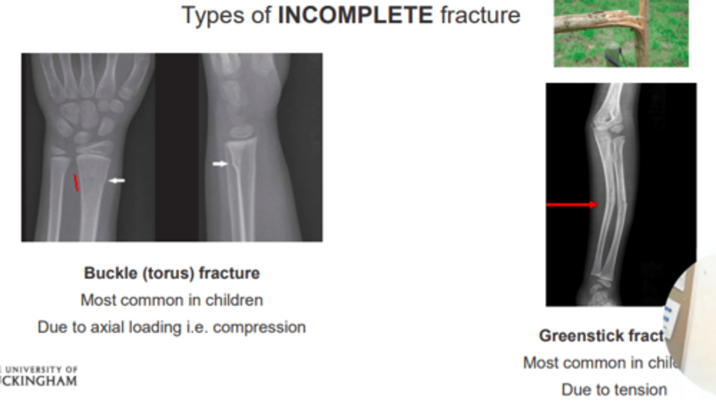 <p>Buckle (torus) fracture</p><p>- Most common in children</p><p>- Due to axial loading e.g., compression</p><p>Greenstick fracture</p><p>- Most common in children</p><p>- Due to tension </p>
