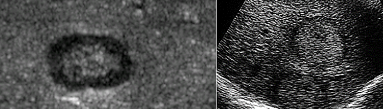 <p>AKA target sign</p><ul><li><p>occurs when center of lesion contains inflammatory cells become calcified </p></li><li><p>causes it to appear echogenic in the center which a hypoechoic rim surrounding the center. </p></li></ul>