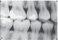 <p>The crowns of the maxillary and mandibular premolars, the distal half of the canine, and the mesial half of the 1st molar.</p>