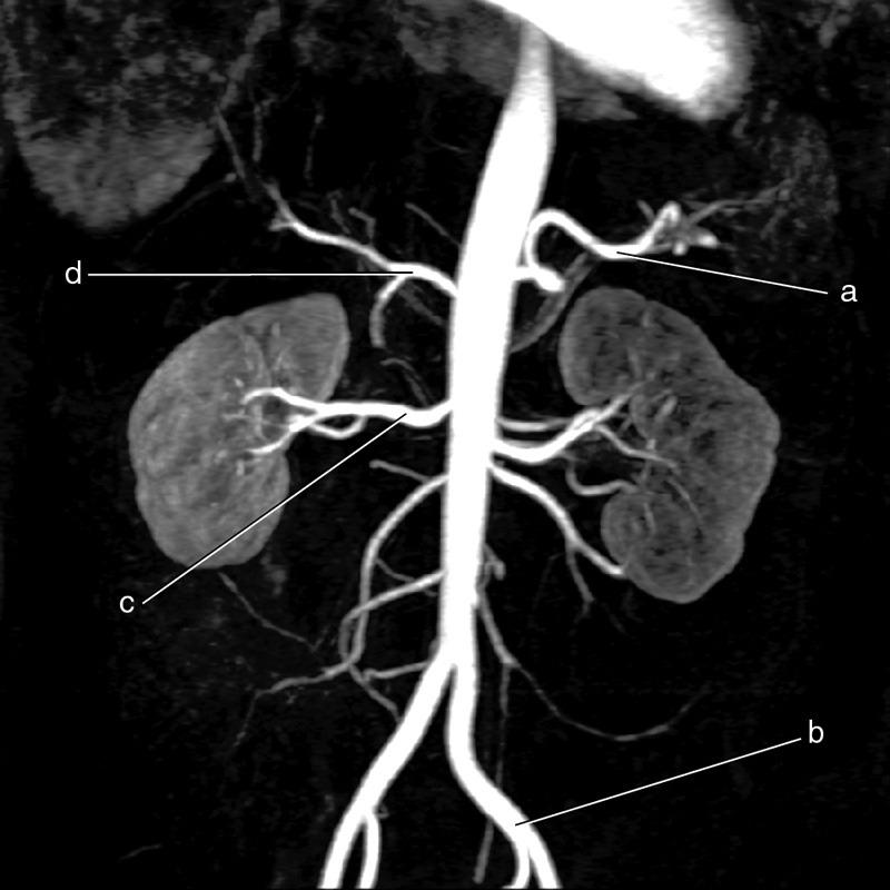 <p><span>Right Renal Artery</span></p>