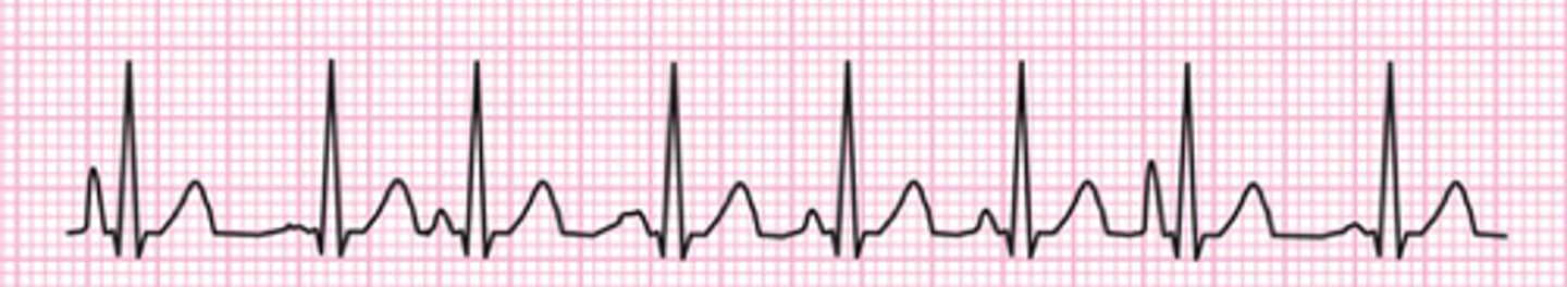 <p>Irregular rhythm with a rate > 100 bpm plus at least 3 different p wave morphologies; severe lung disease (COPD)</p>