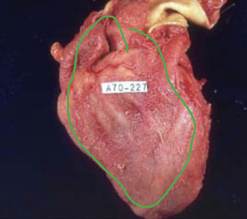 <p>if macrophages fail to completely remove fibrin (lack of resolution), it will organize into granulation tissue with newly formed blood vessels subsequently resulting in scar formation</p>