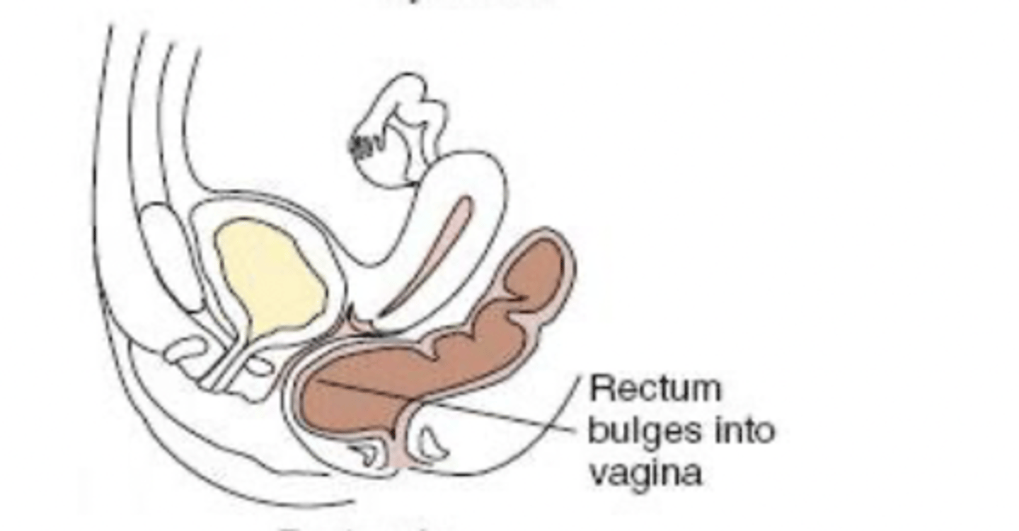 <p>protrusion of the rectum into the posterior vagina that can cause constipation and pain</p>
