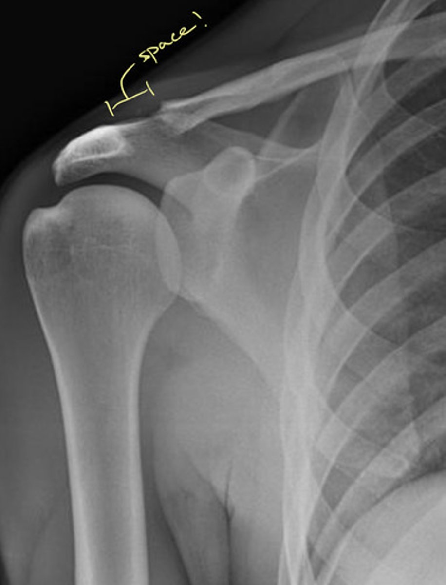 <p>AC joint</p><p>NOTE: take other side image to ensure not from trauma (RA is systemic so most likely bilateral changes)</p>