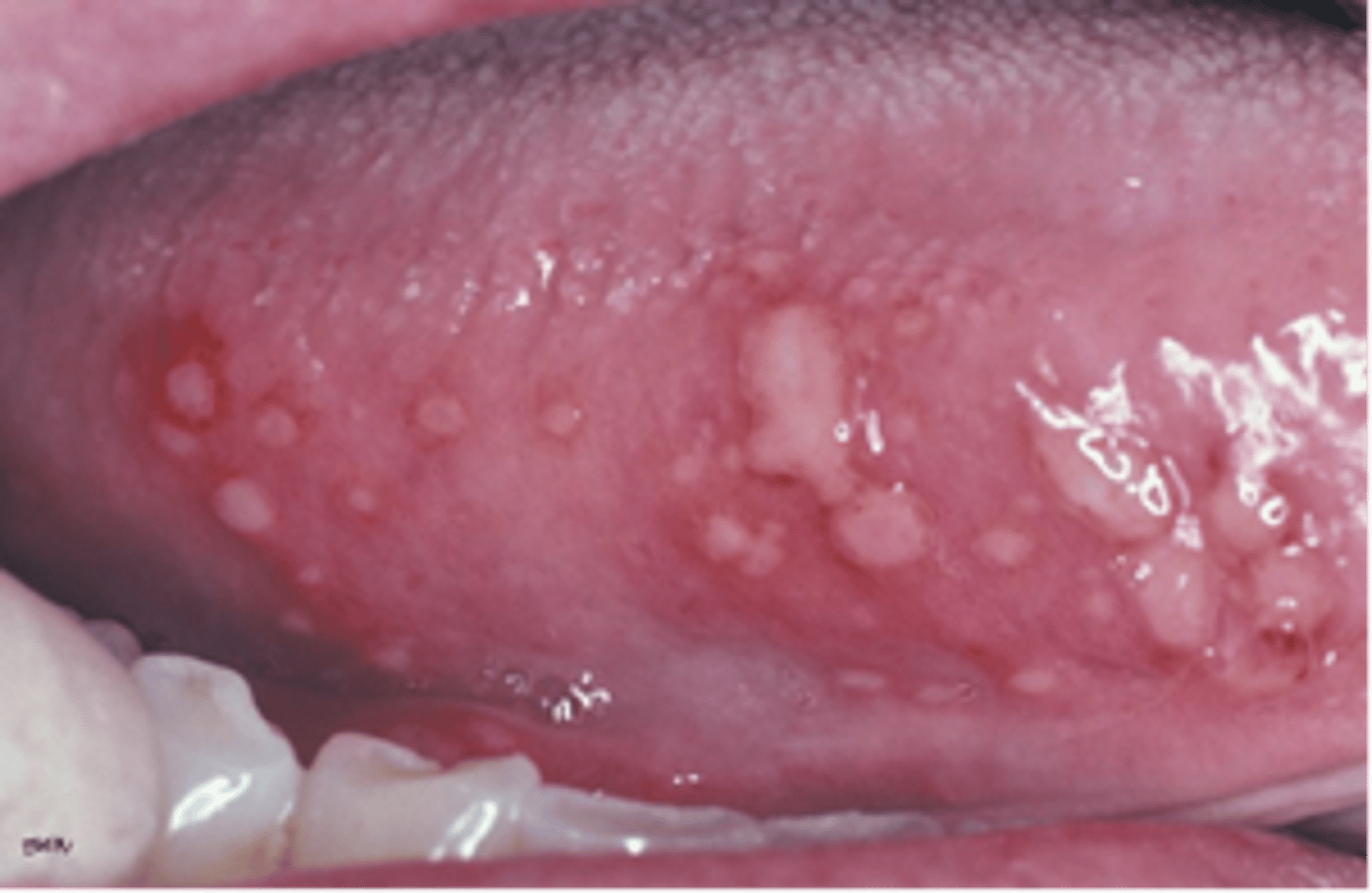 <p>primary herpetic stomatitis, treat with palliative care</p>