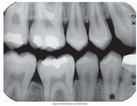<p>How would you resolve this OVERDEVELOPED FILM X-ray?</p>