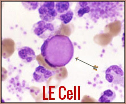 <p>neutrophils or macrophages w/phagocytosed nucleus of another cell, indicates lupus</p><p></p>