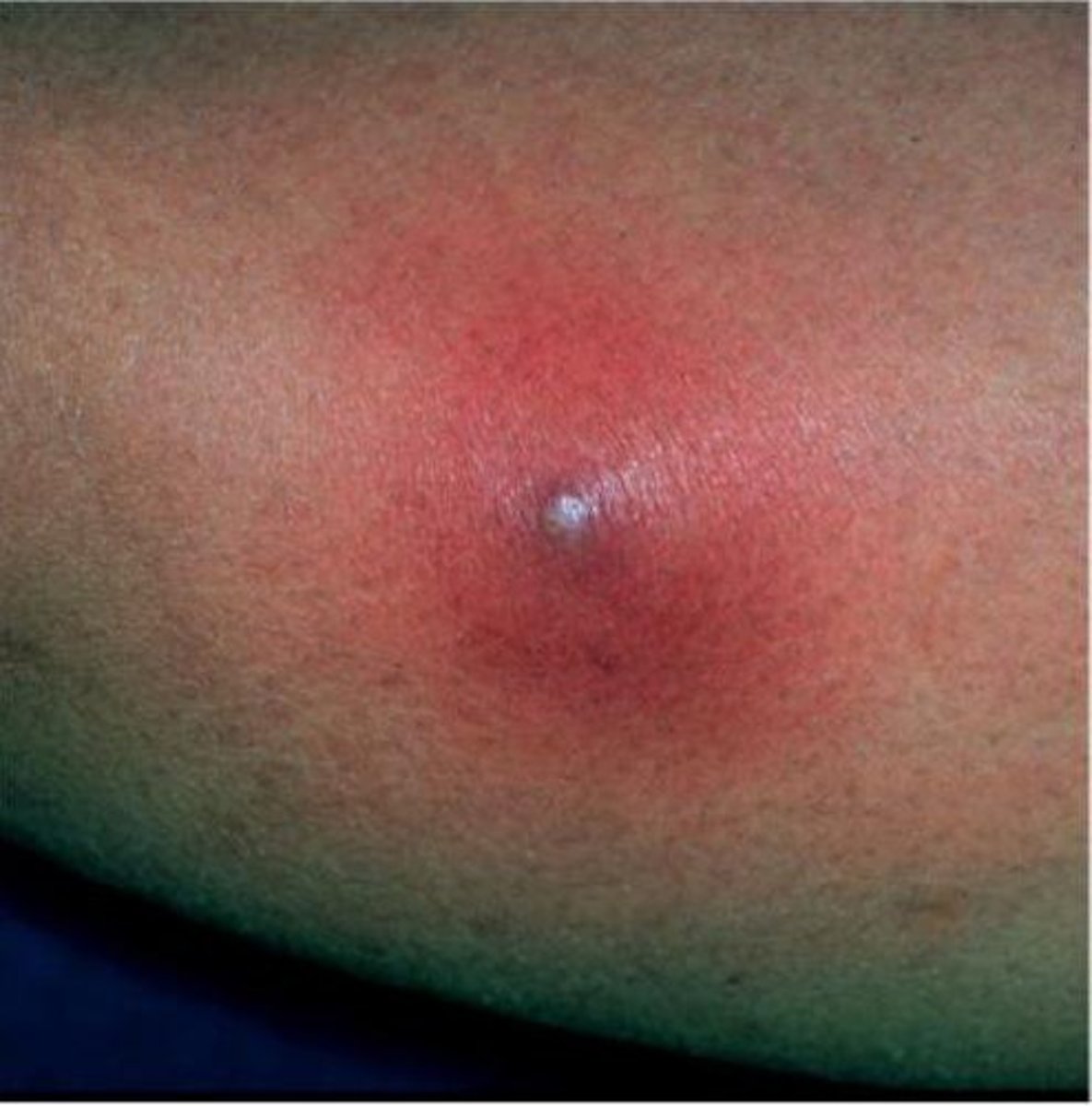 <p>Cavity filled with pus</p><p>Local bacterial infection</p><p>Pull of hair</p><p>Antibiotics and needs to be drained.</p><p>Very painful</p>