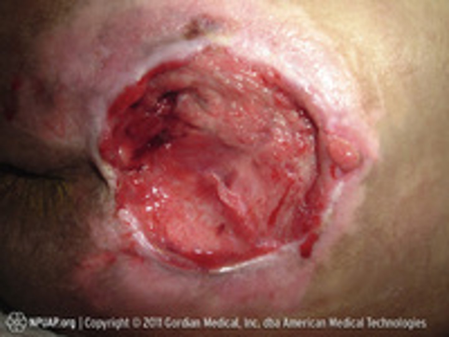 <p>Full-thickness tissue loss with exposed bone, muscle, or tendon</p><p>Epibole, undermining and tunneling may occur</p>