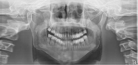 <p><span><span>·</span></span><span style="font-family: "Times New Roman"; line-height: normal; font-size: 7pt;"><span> </span></span><span><span>An “exaggerated smile line” is apparent on the image</span></span></p><p class="MsoListParagraphCxSpLast"><span><span>·</span></span><span style="font-family: "Times New Roman"; line-height: normal; font-size: 7pt;"><span> </span></span><span><span>Smaller mandible, teeth, and a high arch can be seen</span></span></p>