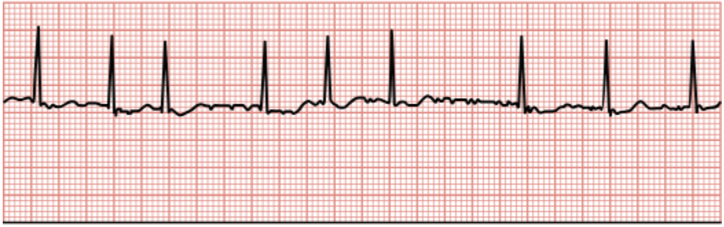 <p>Rapid, disorganized firing of multiple sites within the atrial tissue, resulting in irregular fibrillatory waves between QRS complexes and an irregular QRS rhythm.</p>