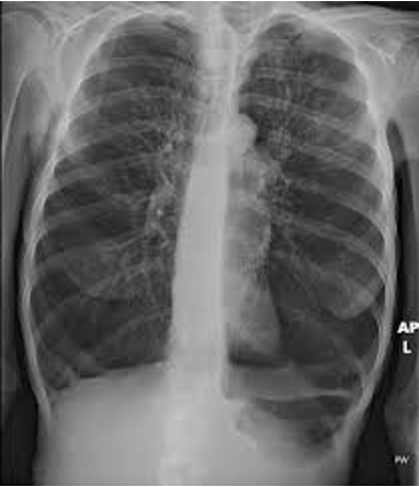 <p>What does this refer to</p><ul><li><p>A 59-year-old man presents to the emergency department with severe pleuritic chest pain. </p></li><li><p>He is worried he might have another collapsed lung. </p></li><li><p>VS – Temp 98.7°F (37.1°C), BP  118/78 mmHg, HR 119/min, RR 31/min, SaO2 85% RA. </p></li><li><p>Exam: he appears cachectic. </p></li><li><p>A chest radiograph is obtained. </p></li><li><p>Document: level of distress, increased work of breathing, +/- use of accessory muscles</p></li></ul><p></p>