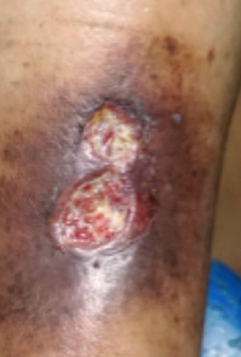 <p>a foot condition caused by constant moisture similar to trench foot</p><p>caused when a mix of bacteria infect a wound on the skin</p>