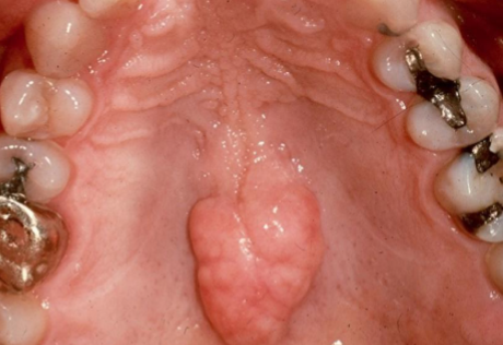 <p>exophytic growth of normal COMPACT bone on hard palate</p>