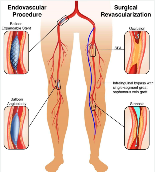 <p><strong>revascularization</strong></p><ul><li><p>basically we physically open up that narrow artery</p></li></ul>