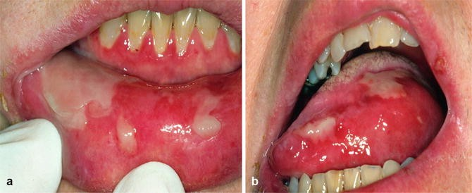 <p>blistering - loss of a <strong>bit of the thickness</strong> in the epithelium. Blister = fluid filled sac </p><ul><li><p>can be because of a cancer </p></li><li><p>Bullae (blistering) causing secondary ulceration - Paraneoplastic</p></li><li><p> <strong>Chemotherapies</strong> </p></li><li><p><strong>Drugs </strong>- hypoglycaemics</p></li></ul><p></p>