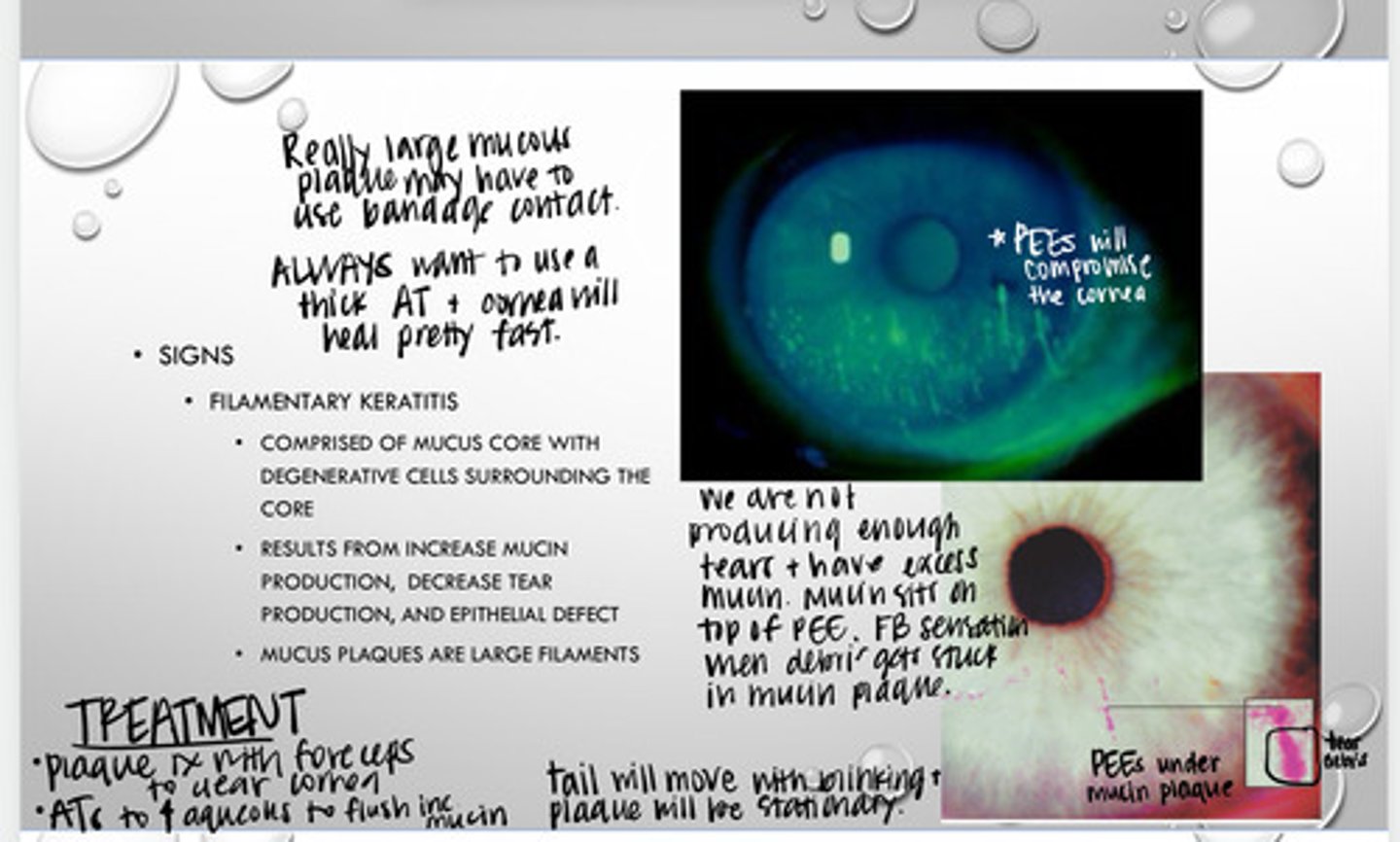 <p>Shape of filamentary keratitis??</p>