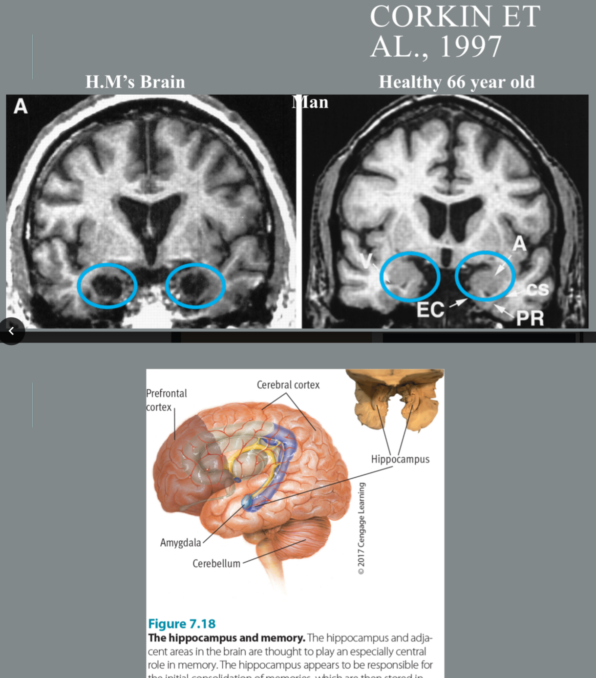 • Impaired Episodic Memory 
        - No new memories

• Impaired Explicit Memory*
       -He does not remember people he met the next day (learning new things)

• Intact Semantic Memory*
        - Remembers everything that had happened before surgery

• Intact Procedural memory
           - how to do things like drawing the star experiment.
