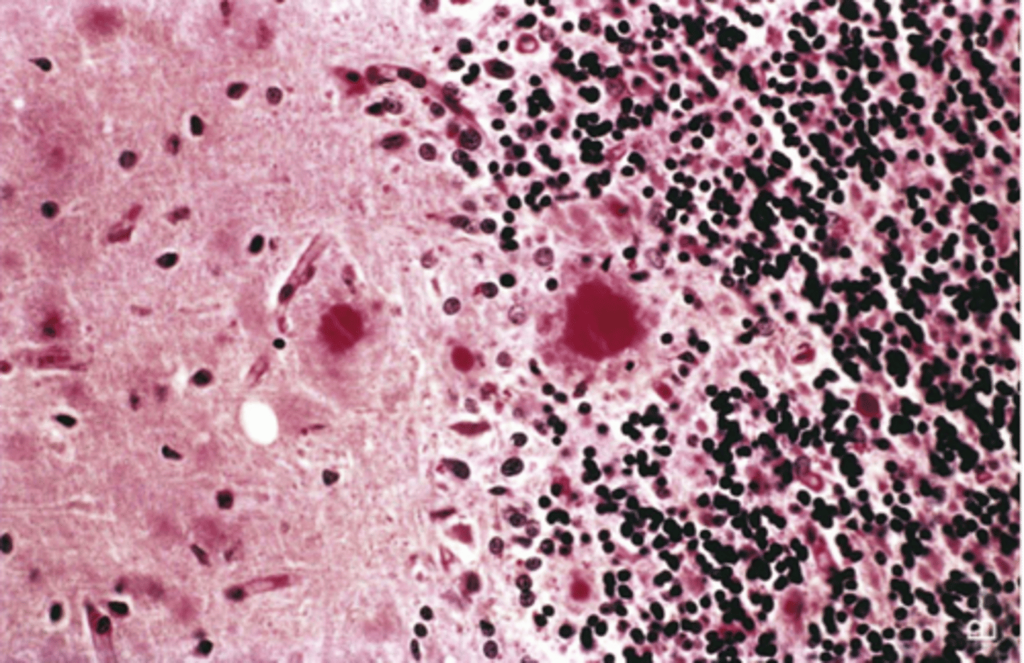 <p>Define Condition:</p><p>-Prion disease </p><p>-Suffered by the Fore due to consuming humans through cannibalism (specifically by consuming the brains/nervous system of the dead)</p><p>-Sx = insomnia, lack of coordination/balance, eventually death</p><p>-See more amyloid plaques</p>