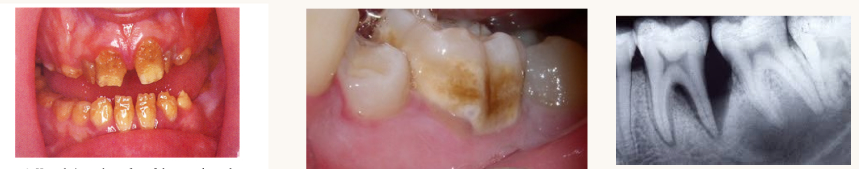 <p>what is this condition and what vitamins is this person likely deficient in?</p>