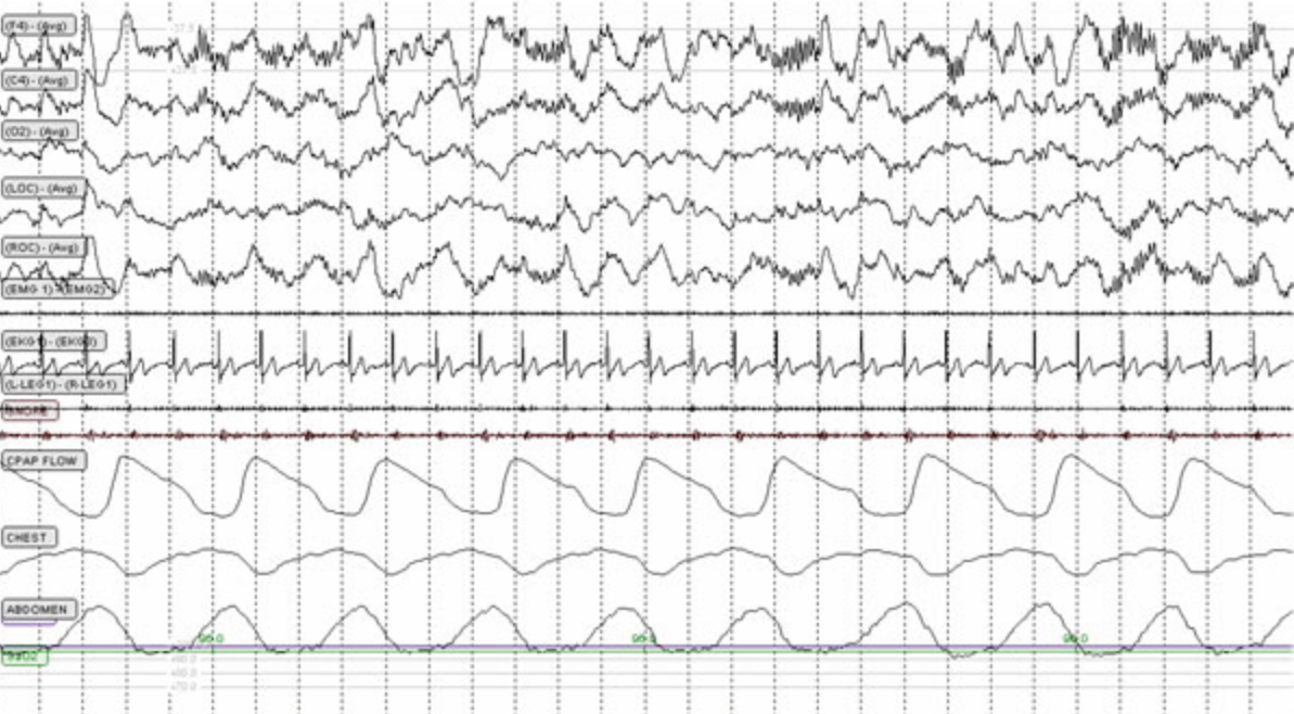 <p>The following 30 second epoch is observed while scoring on an adult patient. This epoch should be scored as stage </p>
