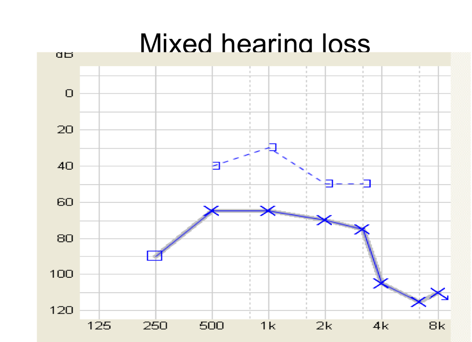Mixed hearing loss 