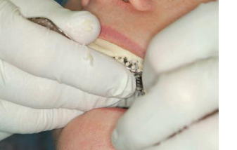 <p><span><strong>1. Mandibular tray </strong></span></p><p><span><strong>2. Maxillary tray </strong></span></p><p><span><strong>3. Postremoval procedure</strong></span></p>