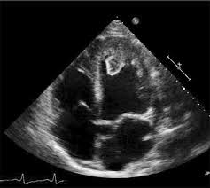 <p>This was taken on a patient who has been diagnosed with postpartum cardiomyopathy and who currently has an ejection fraction of 20%.&nbsp; What is the most likely diagnosis?</p><ul><li><p>left atrial myxoma</p></li><li><p>left mitral valve vegetation</p></li><li><p>left ventricular thrombus</p></li><li><p>right atrial myxoma</p></li></ul><p></p>