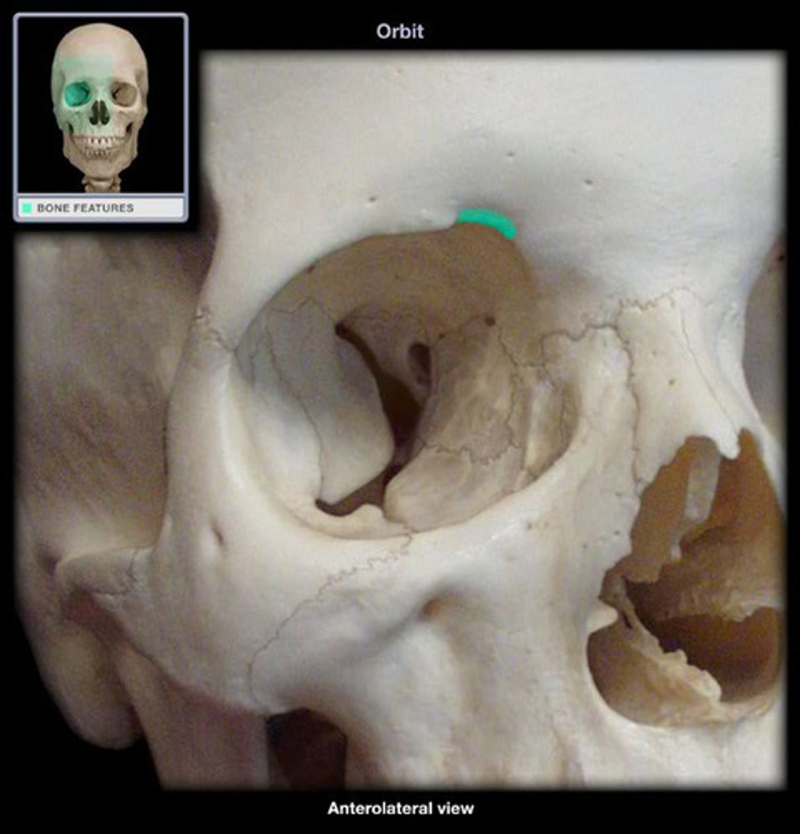 <p>the exit point for the supraorbital nerve and vessels</p>