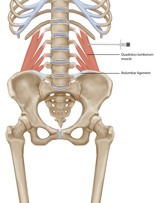 <p>L = deep in posterior wall</p><p>A= flex vertebral column</p>