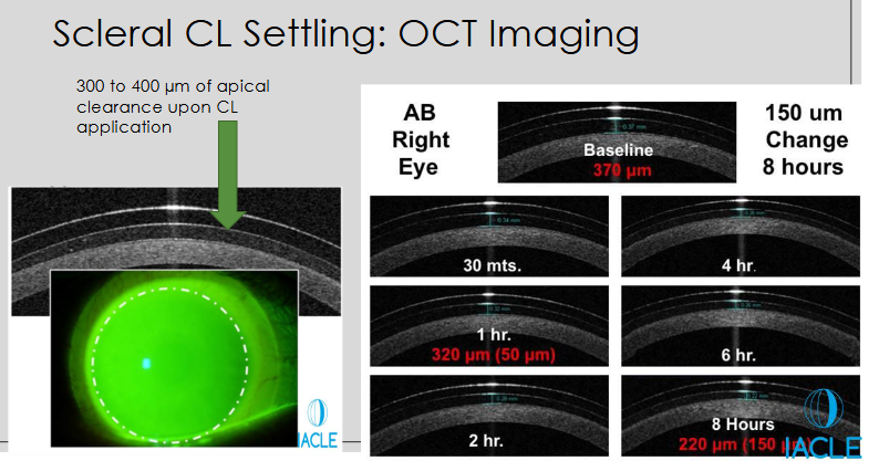 <ul><li><p>Initial <strong>apical clearance</strong> upon application: <strong>300–400 μm</strong></p></li><li><p>Clearance <strong>reduces over time</strong> as the lens settles on the eye</p></li><li><p>Example (Right Eye, baseline 370 μm):</p><ul><li><p>1 hr: 320 μm (<strong>50 μm reduction</strong>)</p></li><li><p>2 hr: 310 μm</p></li><li><p>4 hr: 295 μm</p></li><li><p>6 hr: 280 μm</p></li><li><p>8 hr: 220 μm (<strong>150 μm total reduction</strong>)</p></li></ul></li></ul><p></p>