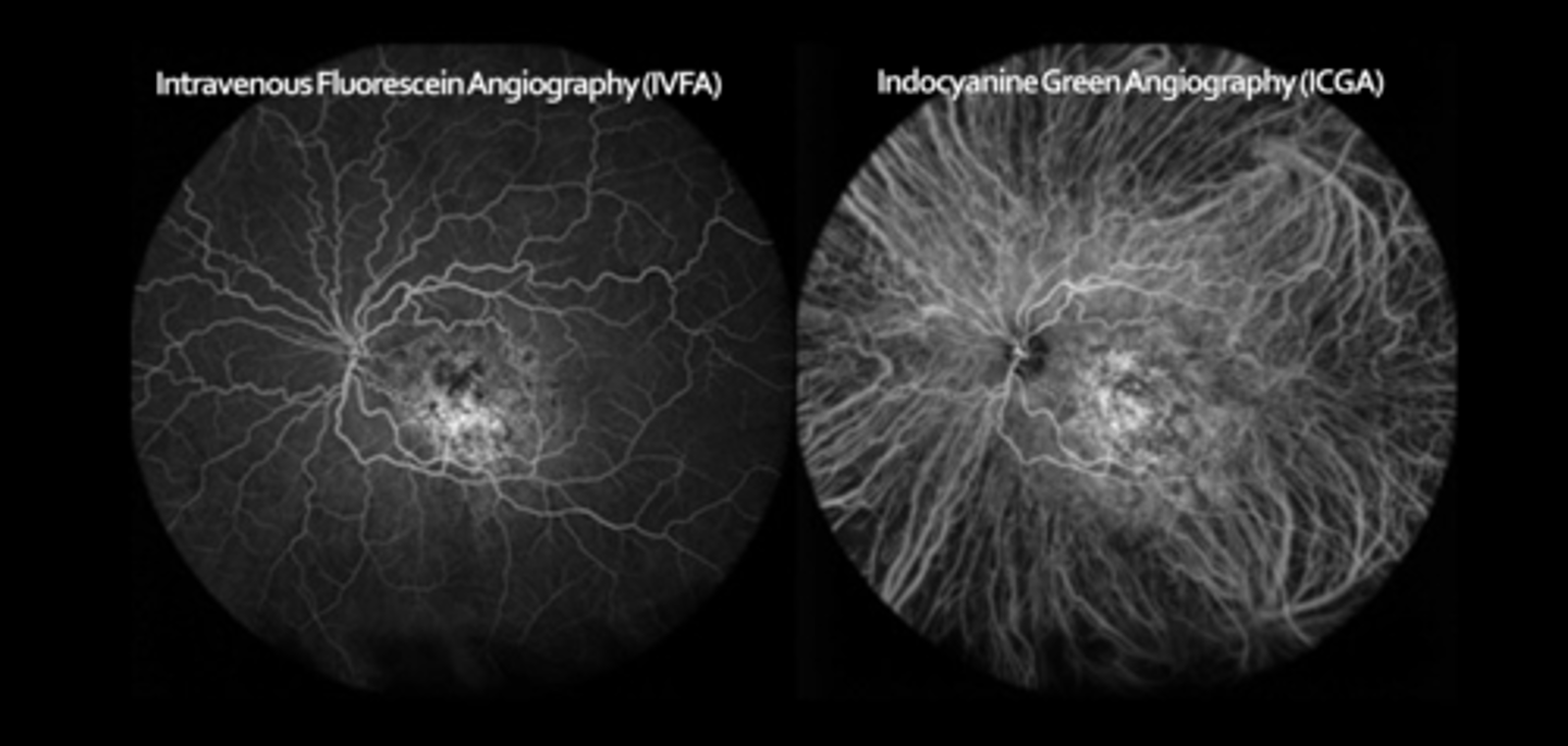 <p>early (0-3 min): maximal hyperF within 1 min, medium and large choroidal BV are filled</p><p>middle (5-15 min): choroidal BV become less distinct, diffuse/homogenous choroidal fluorescence</p><p>late (18-22+ min): details fade, ONH becomes dark, can see contrast of abnormal hyperF lesions at this stage</p>