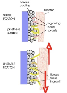 <p>cement<strong>less</strong> hip prosthesis</p>