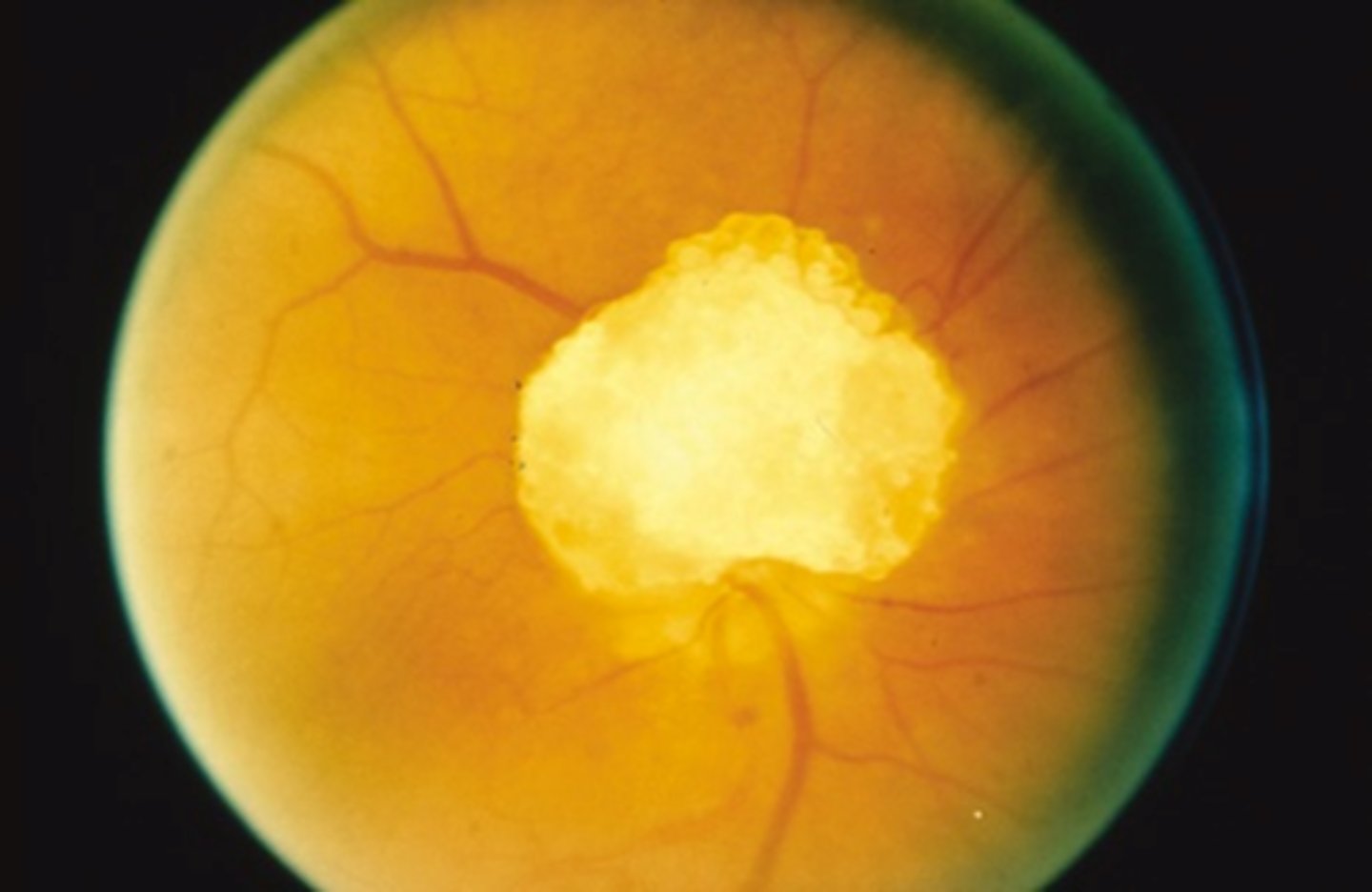 <p>mineralized hamartoma, closely related to ON astrocytic hamartoma, often found in tuberous sclerosis pt's</p>