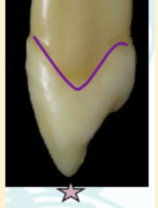 <p><mark data-color="green" style="background-color: green; color: inherit">maxillary canines #6 and #11; proximal view</mark></p>